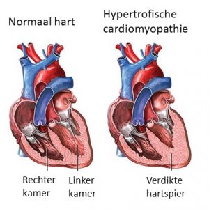 Normaal hart versus hart met HCM 