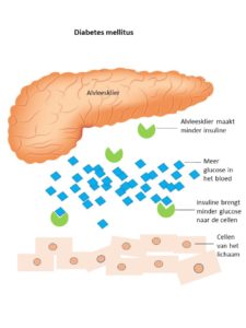 Situatie bij suikerziekte